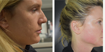 Microneedling before and after photo