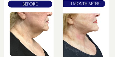 Nonsurgical Facelift before and after photo