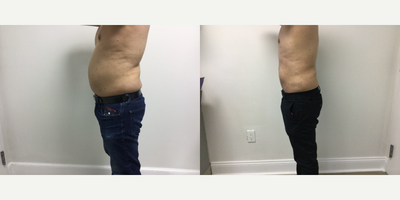 Smart Lipo before and after photo