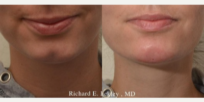 Chin Filler before and after photo