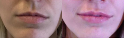 Juvederm before and after photo