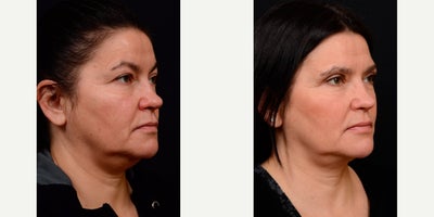 Kybella before and after photo