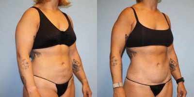 Tummy Tuck before and after photo