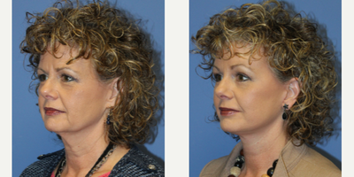 Facelift before and after photo