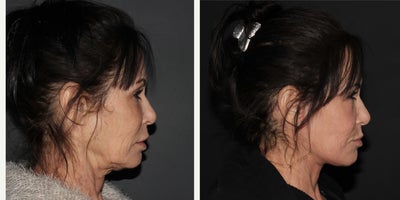 Facial Fat Transfer before and after photo