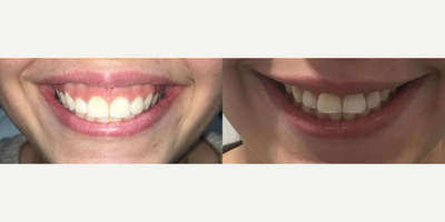 Botox before and after photo