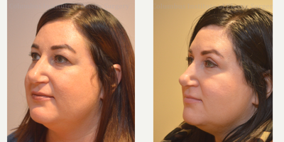 Eyelid Surgery before and after photo