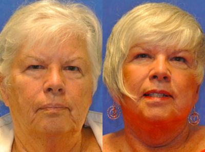 Facelift before and after photo