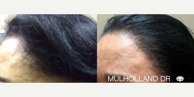 FUE Hair Transplant before and after photo
