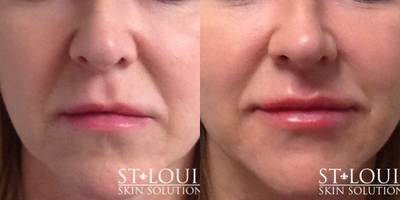 Revanesse before and after photo