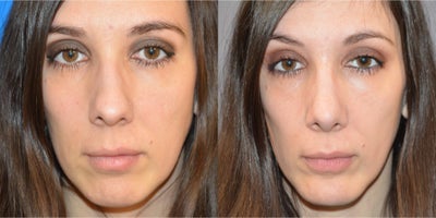 Chin Implant before and after photo