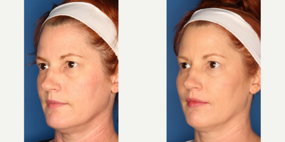 Dermal Fillers before and after photo