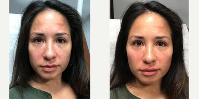 Dermal Fillers before and after photo