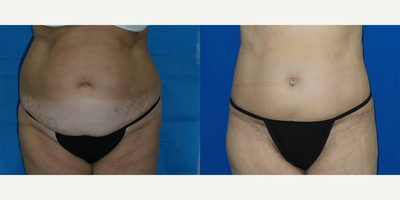 Body Lift before and after photo