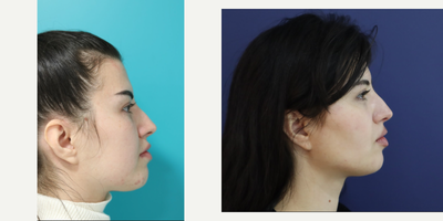 Buccal Fat Removal before and after photo