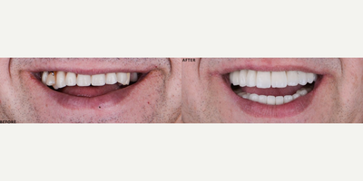 Dental Implants before and after photo