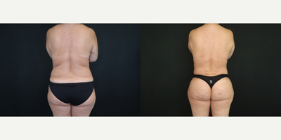 Brazilian Butt Lift before and after photo