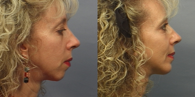 Chin Implant before and after photo