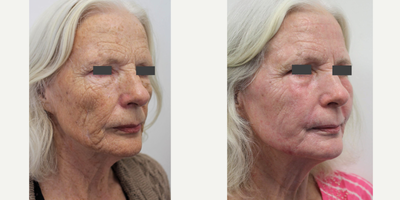CO2 Laser before and after photo