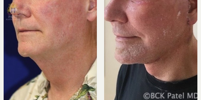 Facelift before and after photo