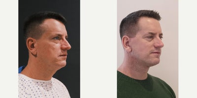 Facelift before and after photo