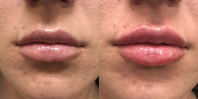 Juvederm before and after photo