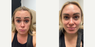 Botox before and after photo