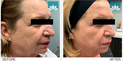 CO2 Laser before and after photo