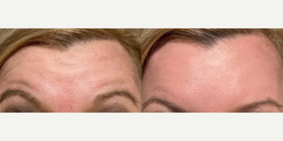 Dysport before and after photo