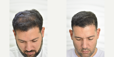 FUE Hair Transplant before and after photo