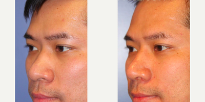 Asian Rhinoplasty before and after photo