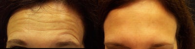 Botox before and after photo