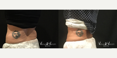 CoolSculpting before and after photo
