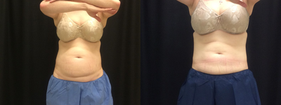 CoolSculpting before and after photo