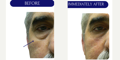 Juvederm before and after photo
