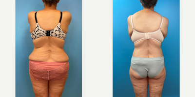 Back Lift before and after photo