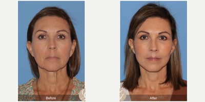 Buccal Fat Removal before and after photo