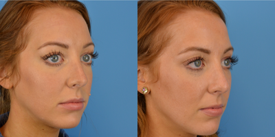 Cheek Fillers before and after photo