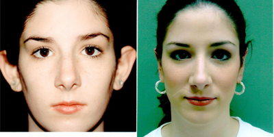 Ear Surgery before and after photo