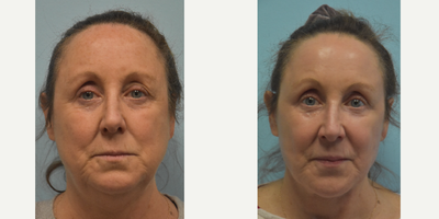 Eyelid Surgery before and after photo