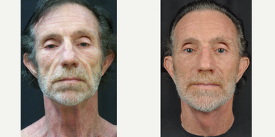 Facelift before and after photo
