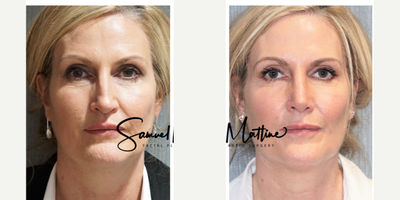 Rhinoplasty before and after photo