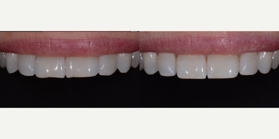 Tooth Repair before and after photo