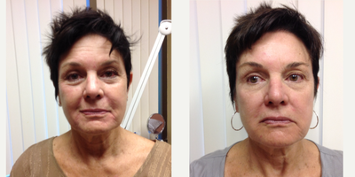 Botox before and after photo