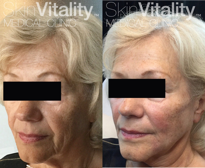 Juvederm before and after photo
