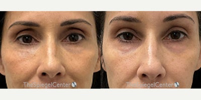 Nonsurgical Nose Job before and after photo