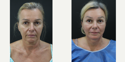 before and after image