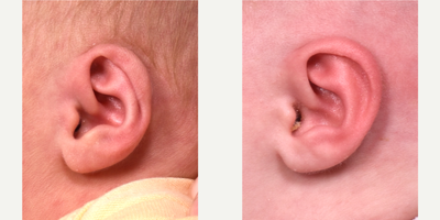 Ear Surgery before and after photo