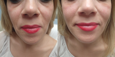 Eyelid Surgery before and after photo