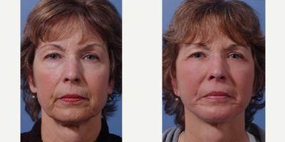 Facelift before and after photo